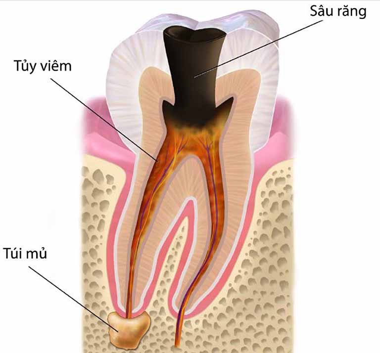 Sâu răng vào tủy có thể gây nhiều biến chứng như viêm tủy răng, áp xe chân răng...