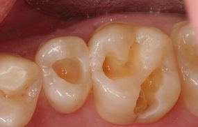 Các cách trị lỗ răng sâu tốt nhất hiện nay và những điều cần lưu ý