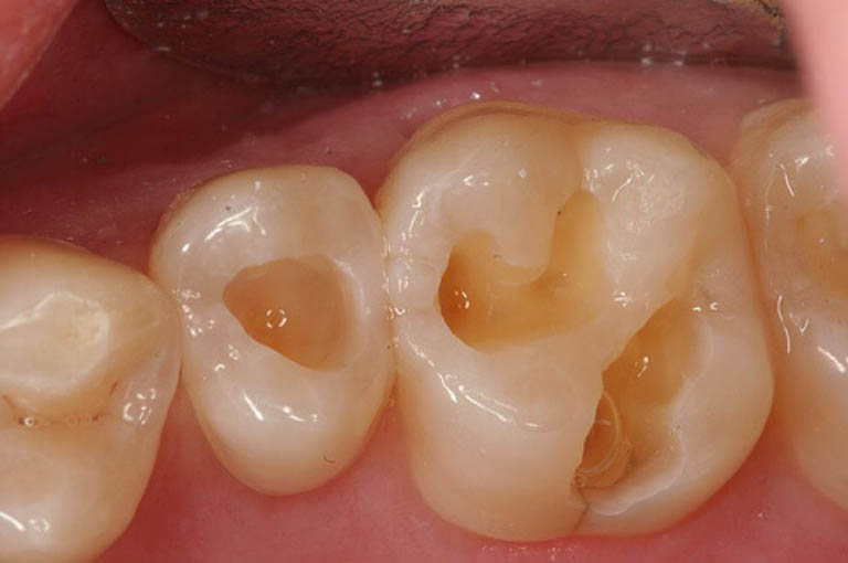Các cách trị lỗ răng sâu tốt nhất hiện nay và những điều cần lưu ý 