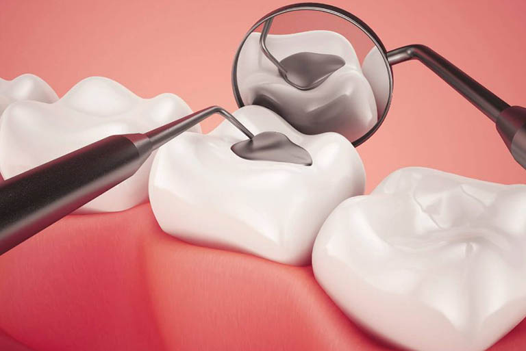 Hàn trám răng là một trong những cách làm liền lỗ sâu răng hiệu quả