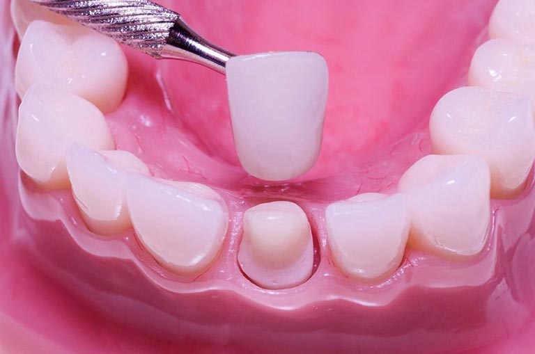 Áp dụng các cách trị răng bị lủng lỗ tại nhà không thể điều trị được lỗ răng sâu to 