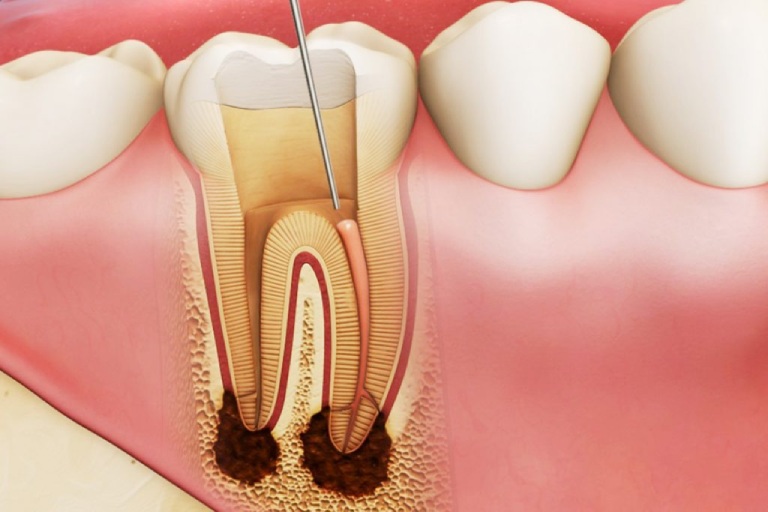 điều trị răng hàm bị sâu đau nhức