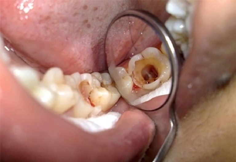 Sâu răng hàm gây đau nhức nguy hiểm không