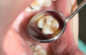 sâu răng hàm