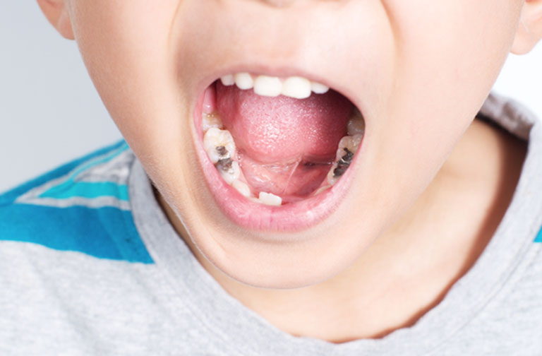 Bé 5 tuổi bị sâu răng hàm phải làm sao