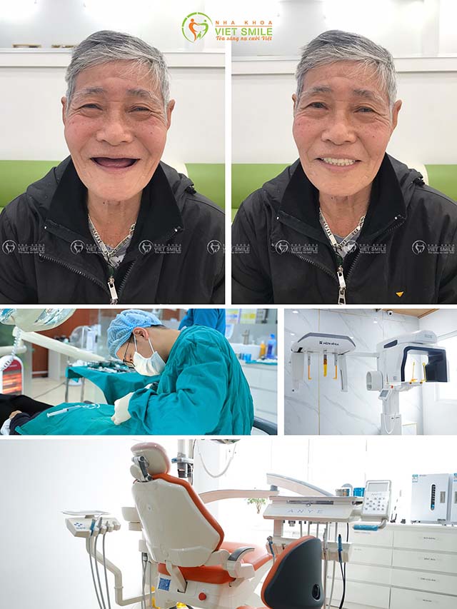Trồng răng implant TPHCM uy tín nhất VietSmile